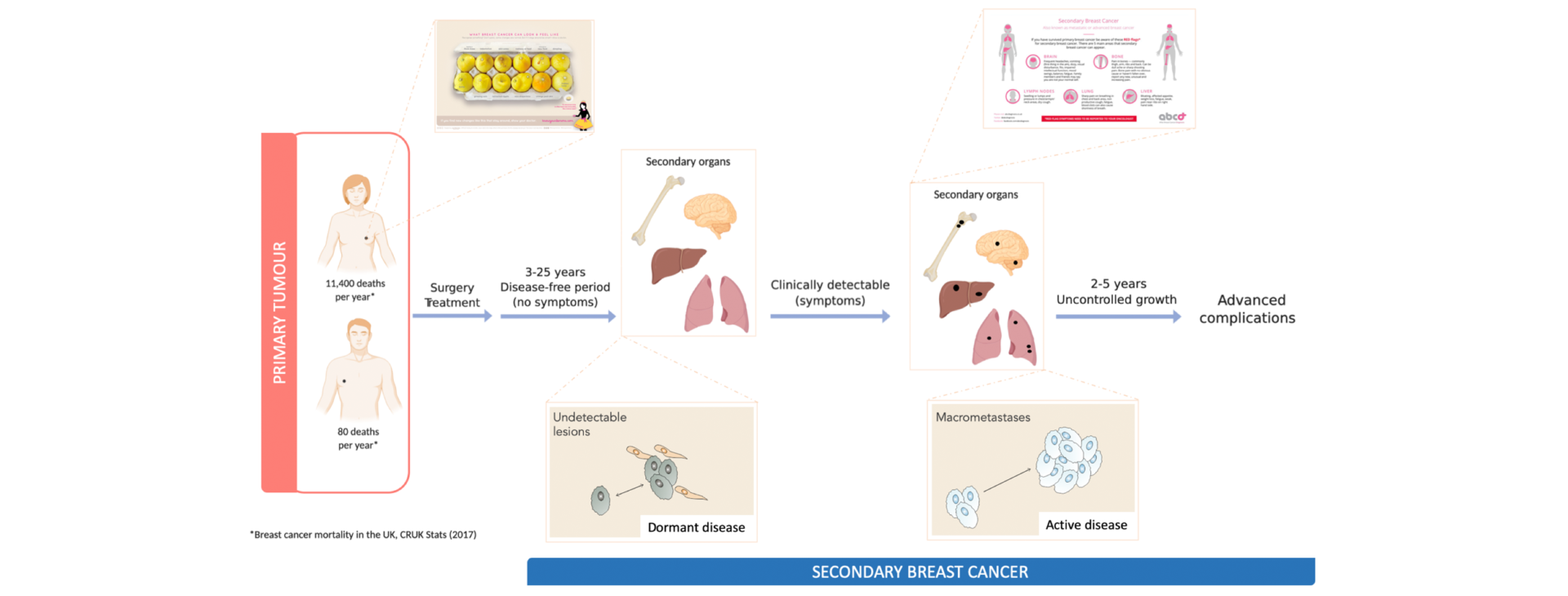 Manchester Cancer Research Centre | But… What about secondary breast cancer?