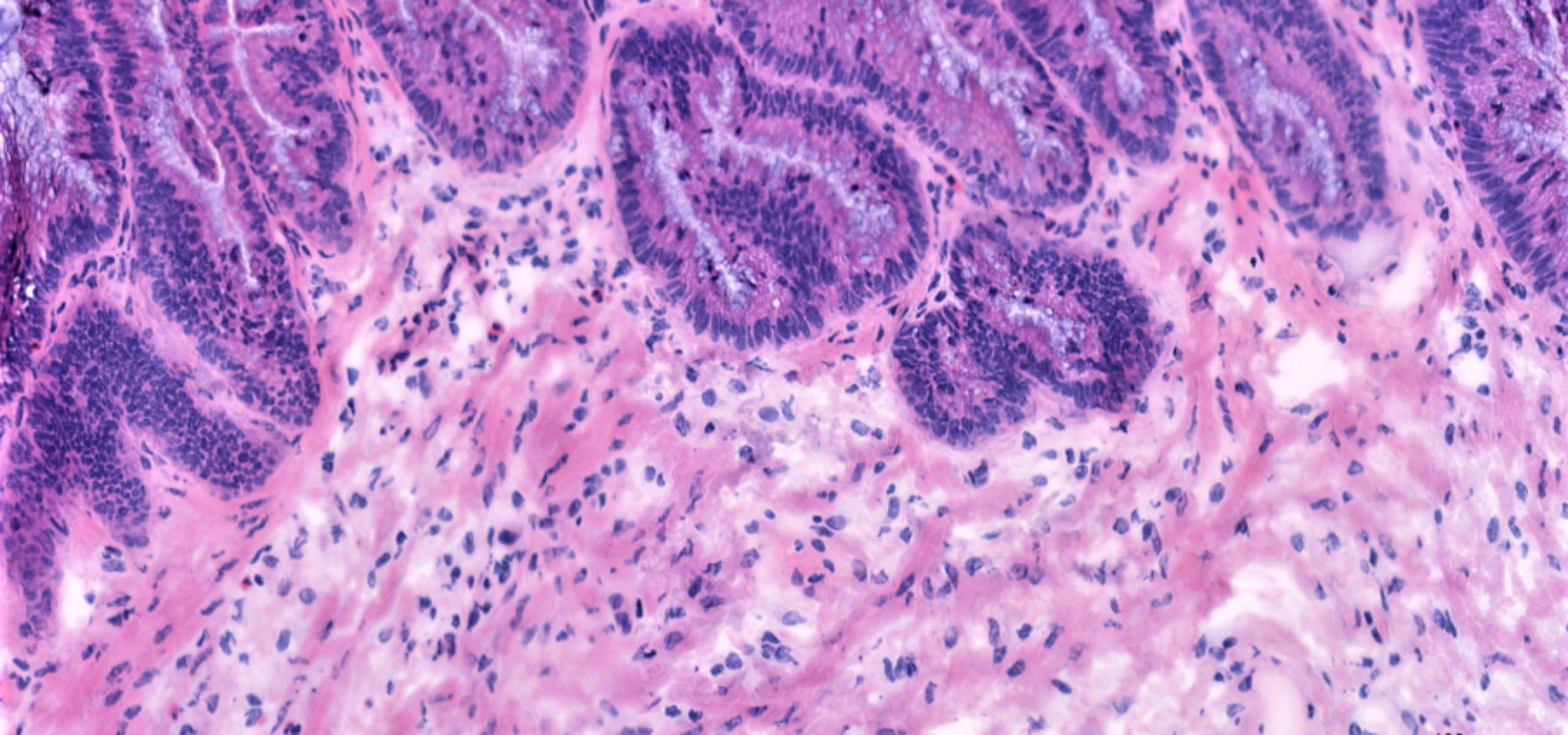 Peritoneal metastases