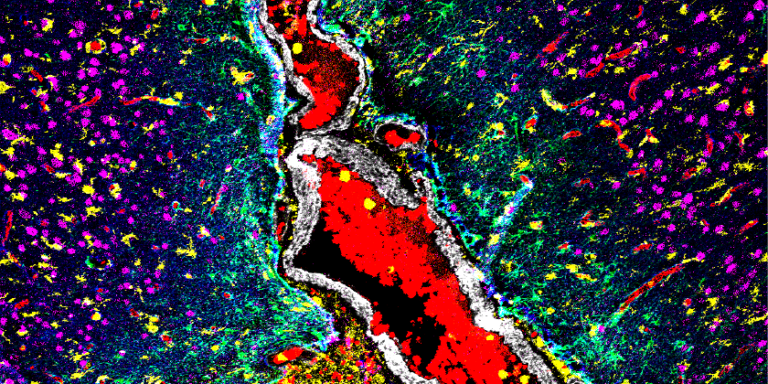 Manchester Cancer Research Centre - The Christie trials pioneering pre-surgery treatment for brain tumours