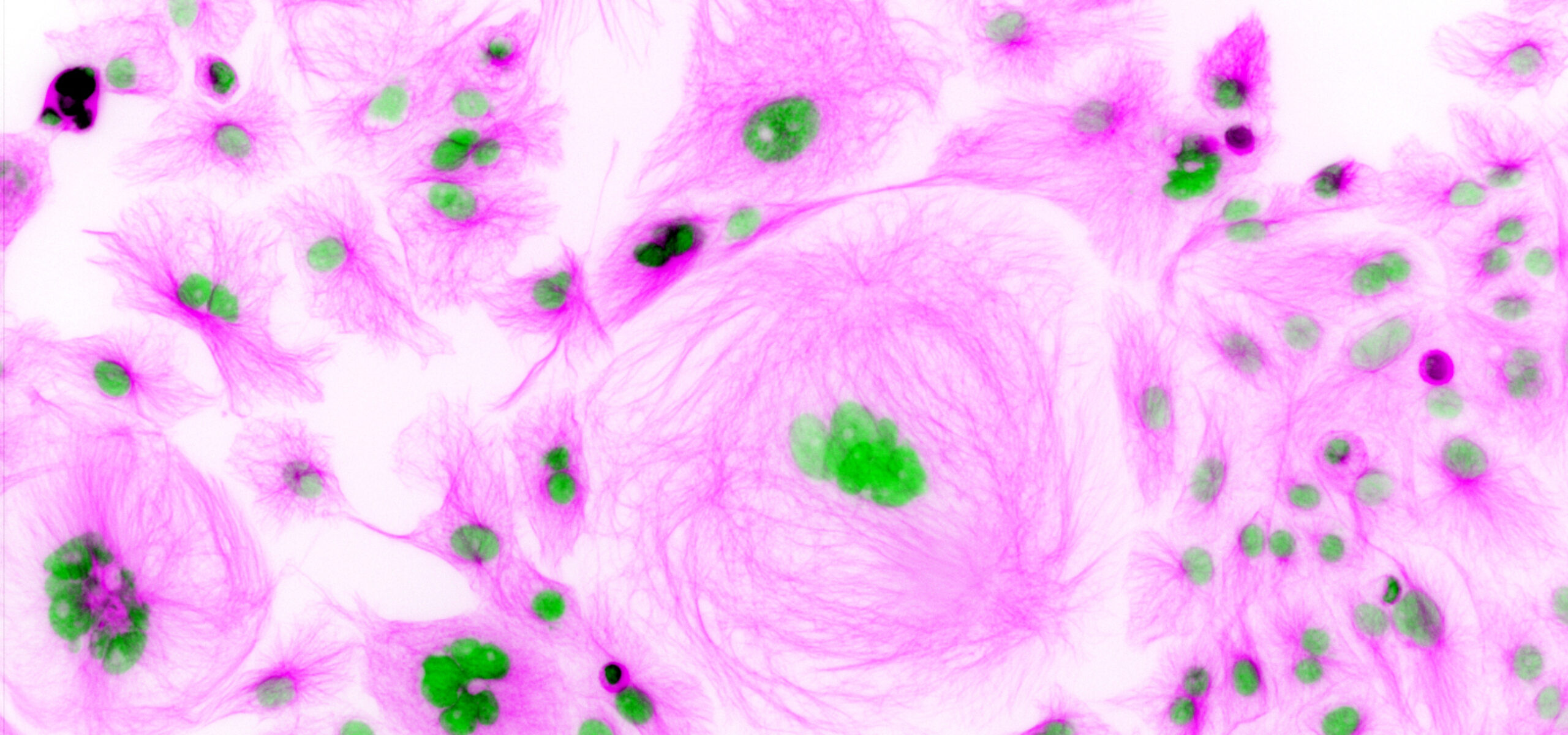 Ovarian Cancer Cells (HSOC)