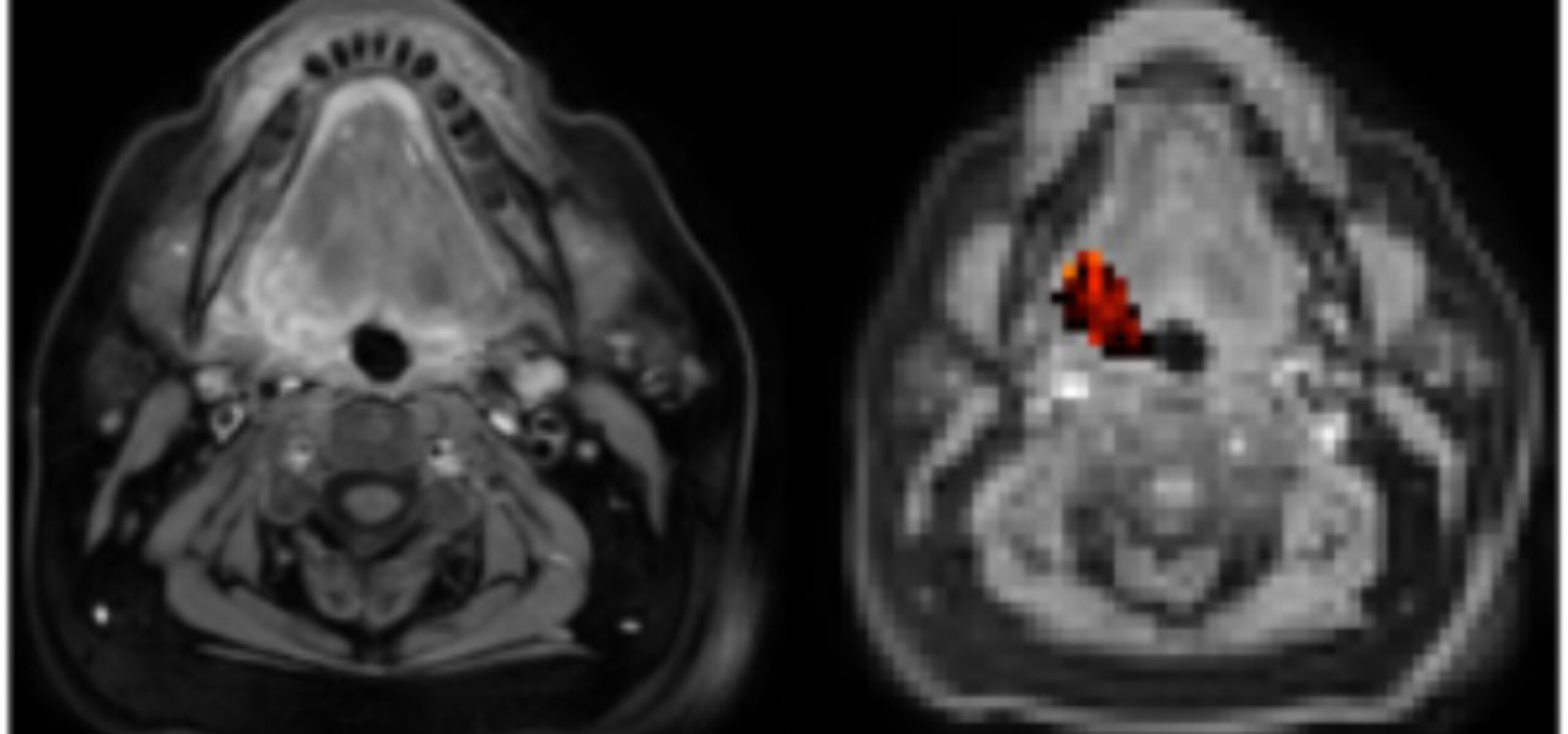 Hypoxic tumours being imaged through the MR-Linac